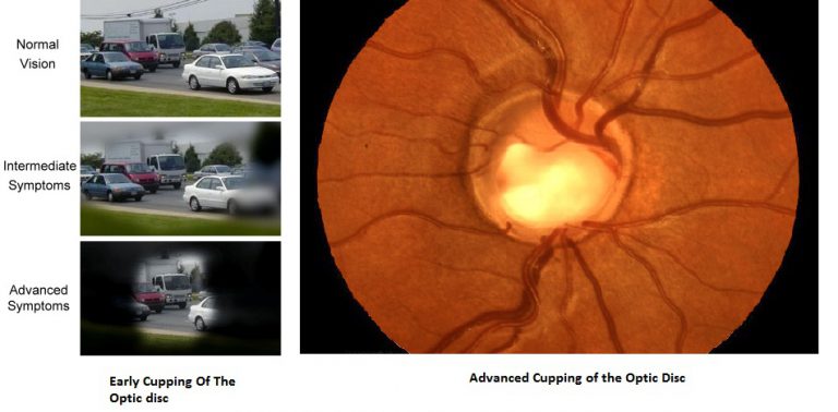 Glaucoma1-1-768x378