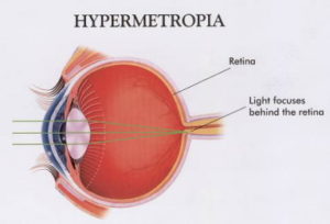 hypermetropia